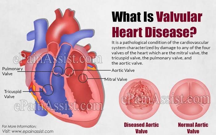 valvular-heart-disease-rmi